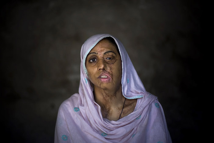 Shameem Akhter attacked with acid