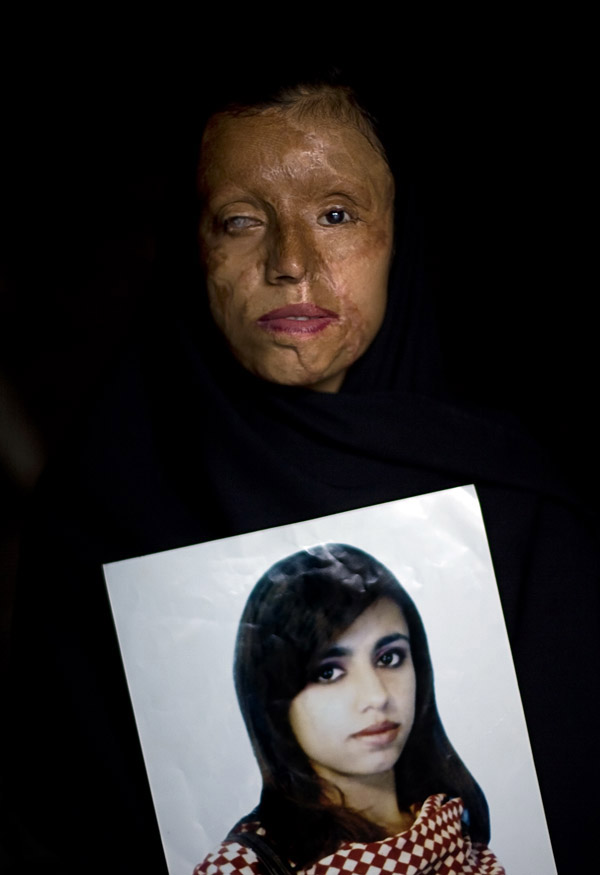 Saira Liaqat attacked with acid
